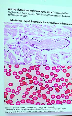 [VIDEO] W tej chorobie liczy się dosłownie każda godzina. W Polsce jej rozpoznanie wciąż jest problemem, a bez diagnozy 90 proc. chorych umrze w ciągu dwóch tygodni